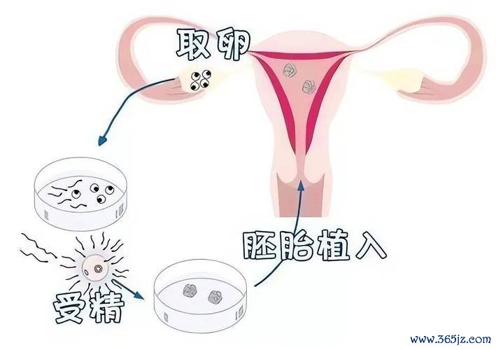 人工助孕技术详解试管婴儿与胚胎移植优势 人工助孕技术详解试管婴儿与胚胎移植优势