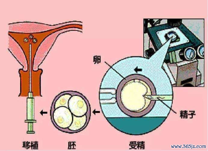 人工助孕方案解析助孕技术优势 人工助孕方案解析助孕技术优势